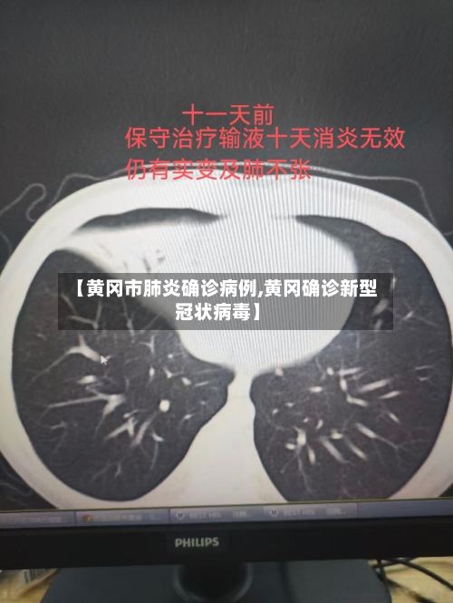 【黄冈市肺炎确诊病例,黄冈确诊新型冠状病毒】