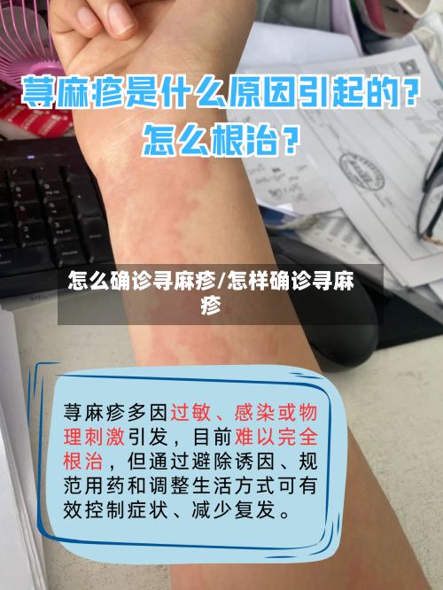 怎么确诊寻麻疹/怎样确诊寻麻疹