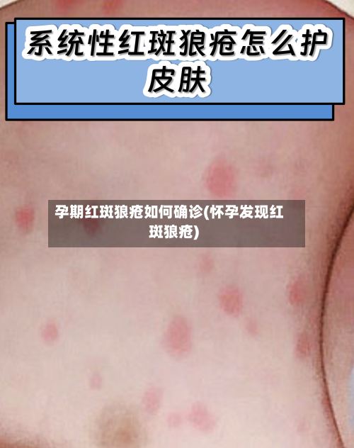 孕期红斑狼疮如何确诊(怀孕发现红斑狼疮)-第3张图片