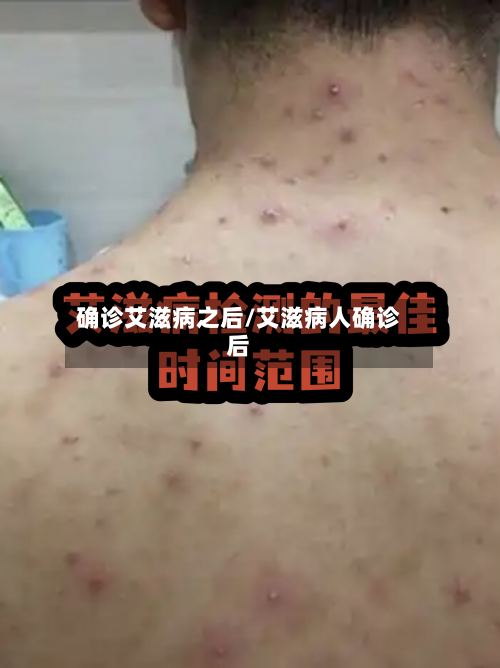 确诊艾滋病之后/艾滋病人确诊后