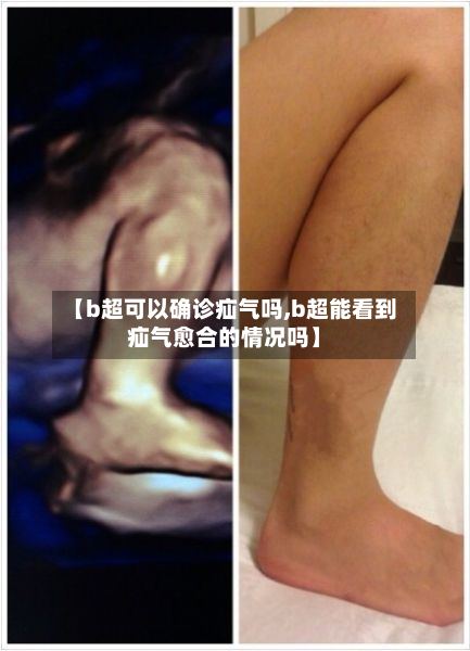 【b超可以确诊疝气吗,b超能看到疝气愈合的情况吗】