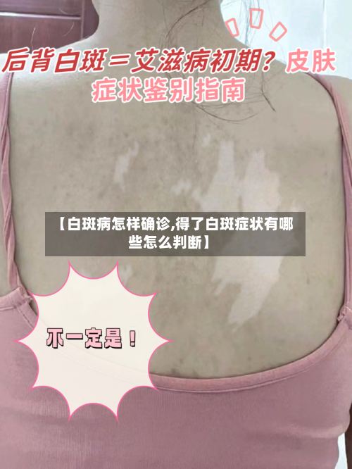 【白斑病怎样确诊,得了白斑症状有哪些怎么判断】-第2张图片