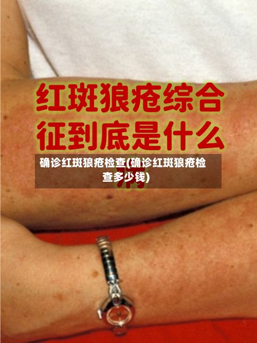 确诊红斑狼疮检查(确诊红斑狼疮检查多少钱)-第3张图片