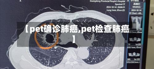 【pet确诊肺癌,pet检查肺癌】-第3张图片