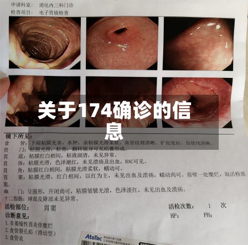 关于174确诊的信息