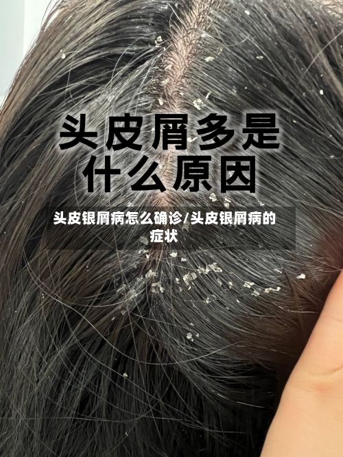 头皮银屑病怎么确诊/头皮银屑病的症状-第3张图片