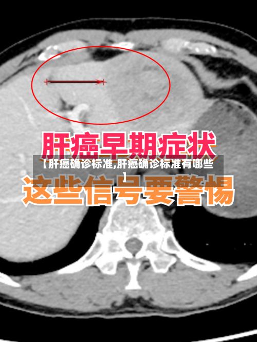 【肝癌确诊标准,肝癌确诊标准有哪些】-第2张图片