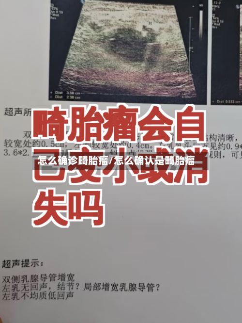 怎么确诊畸胎瘤/怎么确认是畸胎瘤-第2张图片