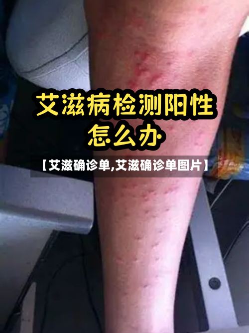 【艾滋确诊单,艾滋确诊单图片】-第2张图片