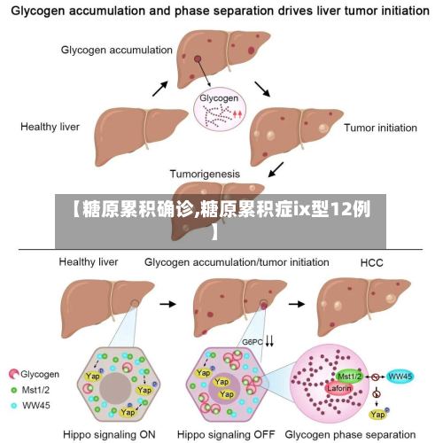 【糖原累积确诊,糖原累积症ix型12例】-第2张图片