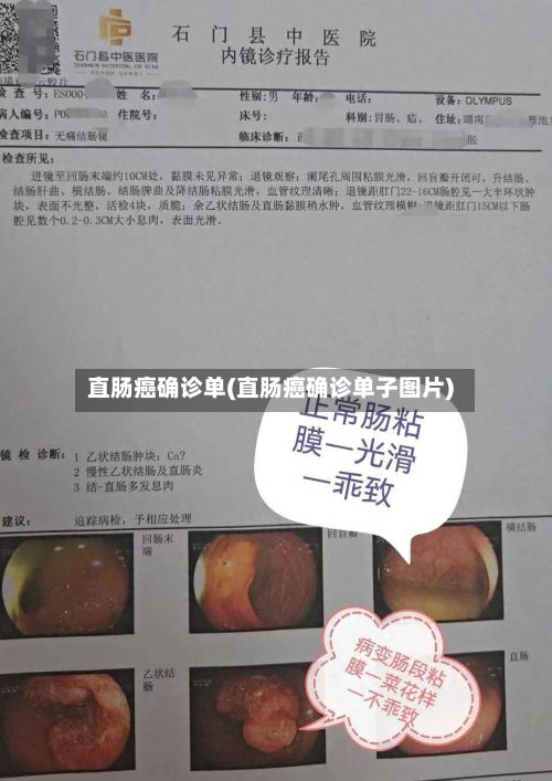 直肠癌确诊单(直肠癌确诊单子图片)-第2张图片