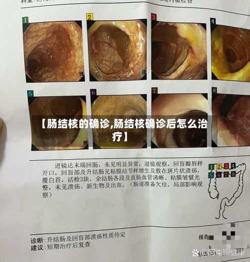 【肠结核的确诊,肠结核确诊后怎么治疗】-第3张图片